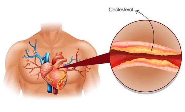 You are currently viewing Eat These Foods To Reduce Cholesterol Levels In Your Blood